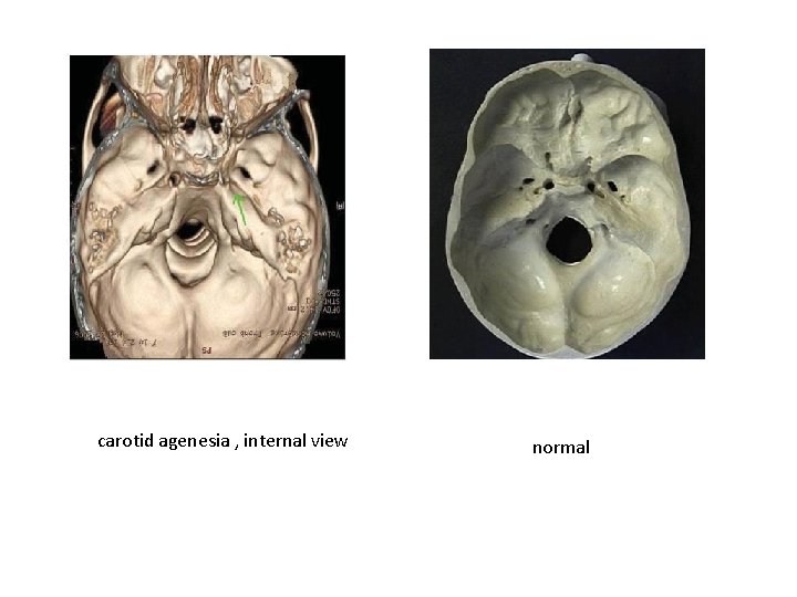 carotid agenesia , internal view normal 
