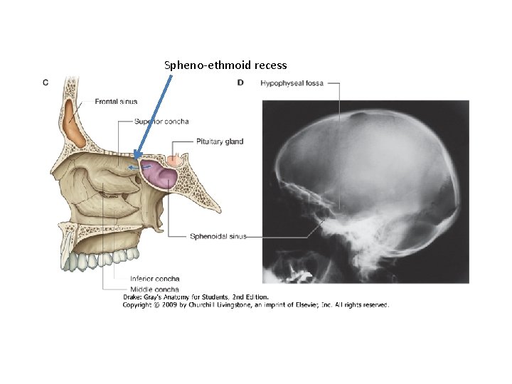 Spheno-ethmoid recess 