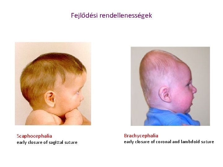 Fejlődési rendellenességek Scaphocephalia early closure of sagittal suture Brachycephalia early closure of coronal and