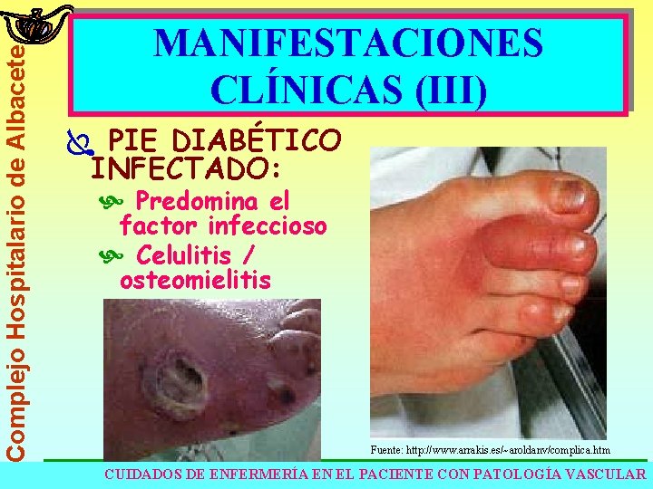 Complejo Hospitalario de Albacete MANIFESTACIONES CLÍNICAS (III) Ï PIE DIABÉTICO INFECTADO: Predomina el factor