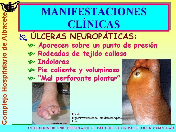 Complejo Hospitalario de Albacete MANIFESTACIONES CLÍNICAS Ï ÚLCERAS NEUROPÁTICAS: Aparecen sobre un punto de