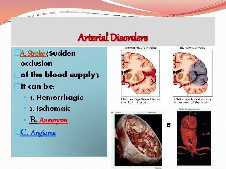 Arterial Disorders �A. Stroke (Sudden occlusion �of the blood supply): �It can be: §