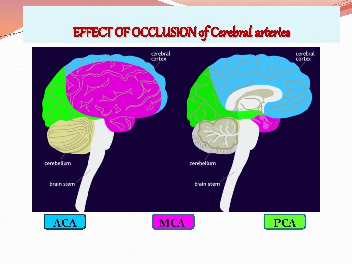 EFFECT OF OCCLUSION of Cerebral arteries ACA MCA PCA 