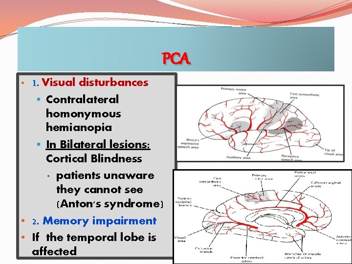 PCA • 1. Visual disturbances § Contralateral homonymous hemianopia § In Bilateral lesions: Cortical