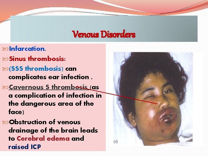 Venous Disorders Infarcation. Sinus thrombosis: (SSS thrombosis) can complicates ear infection. Cavernous S thrombosis