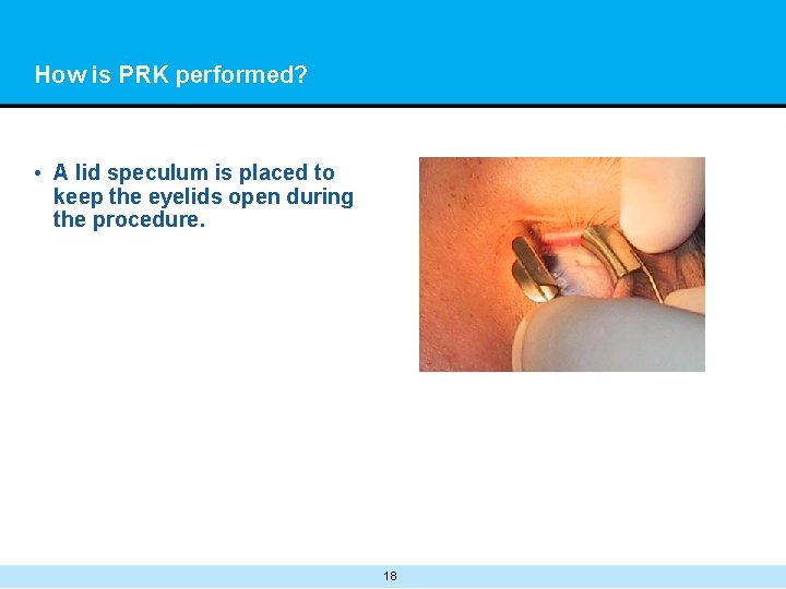 How is PRK performed? • A lid speculum is placed to keep the eyelids