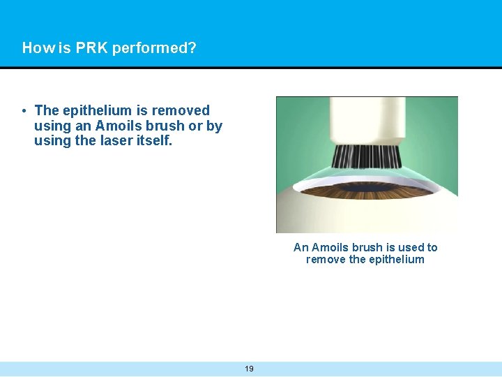 How is PRK performed? • The epithelium is removed using an Amoils brush or