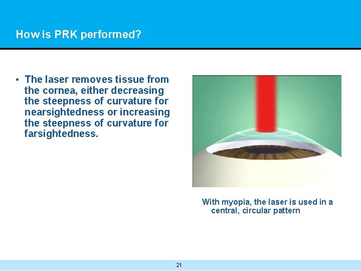 How is PRK performed? • The laser removes tissue from the cornea, either decreasing