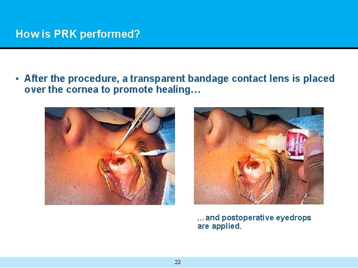 How is PRK performed? • After the procedure, a transparent bandage contact lens is