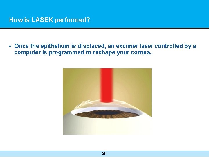 How is LASEK performed? • Once the epithelium is displaced, an excimer laser controlled