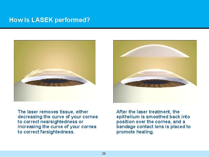 How is LASEK performed? The laser removes tissue, either decreasing the curve of your