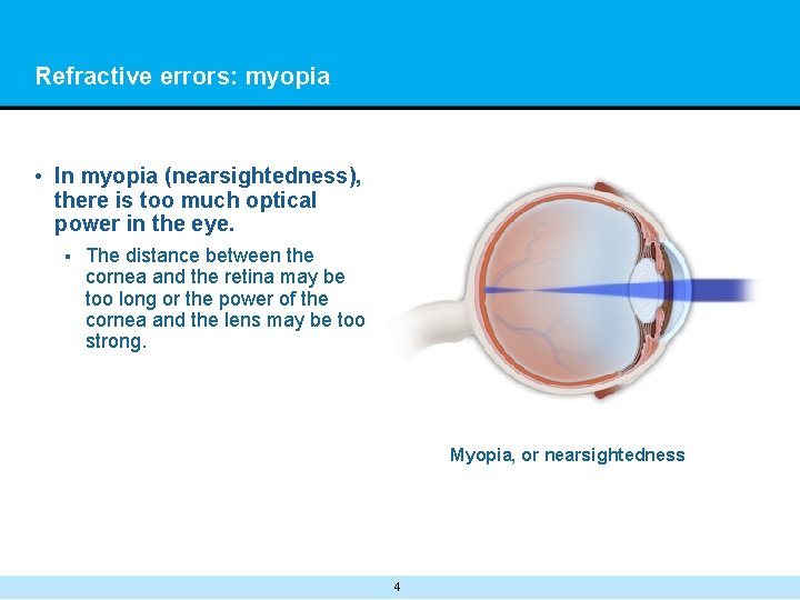 Refractive errors: myopia • In myopia (nearsightedness), there is too much optical power in