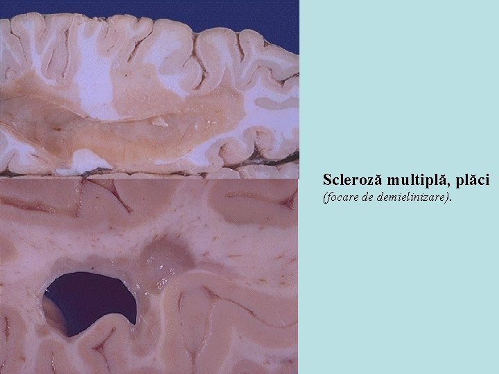 Scleroză multiplă, plăci (focare de demielinizare). Scleroză multiplă, plăci (focare de demielinizare).