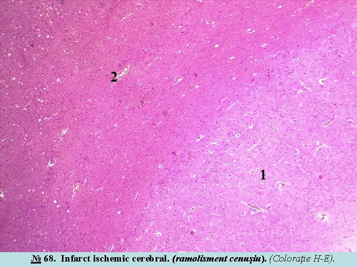 2 1 № 68. Infarct ischemic cerebral. (ramolisment cenuşiu). (Coloraţie H-E). 2 1 № 68. Infarct ischemic cerebral. (ramolisment cenuşiu). (Coloraţie H-E).