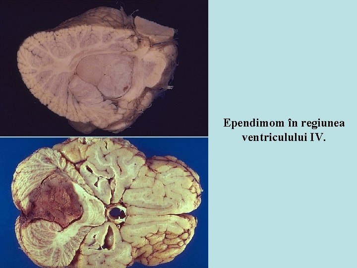Ependimom în regiunea ventriculului IV. Ependimom în regiunea ventriculului IV.