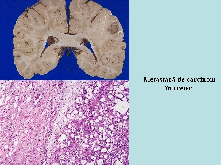 Metastază de carcinom în creier. Metastază de carcinom în creier.