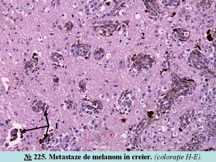 2 1 № 225. Metastaze de melanom în creier. (coloraţie H-E). 2 1 № 225. Metastaze de melanom în creier. (coloraţie H-E).