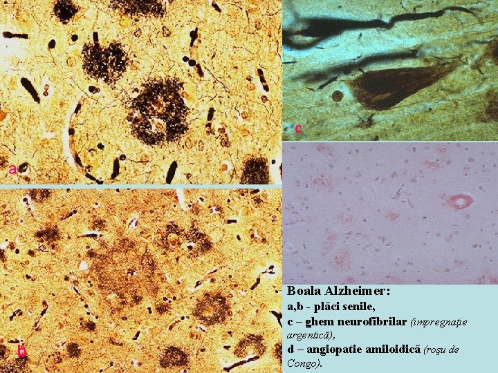 c a Boala Alzheimer: a, b - plăci senile, c – ghem neurofibrilar (impregnaţie c a Boala Alzheimer: a, b - plăci senile, c – ghem neurofibrilar (impregnaţie