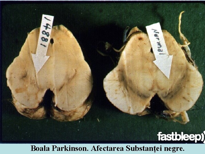 Boala Parkinson. Afectarea Substanței negre. Boala Parkinson. Afectarea Substanței negre.