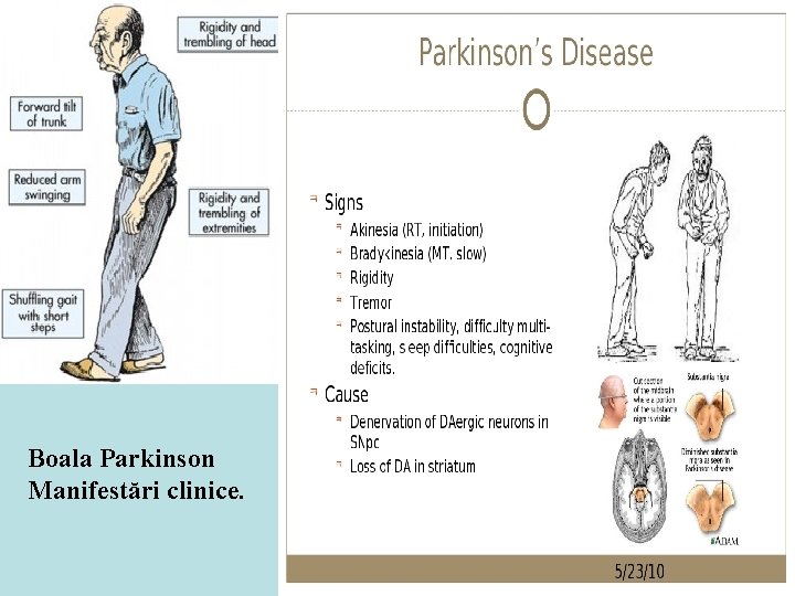 Boala Parkinson Manifestări clinice. Boala Parkinson Manifestări clinice.