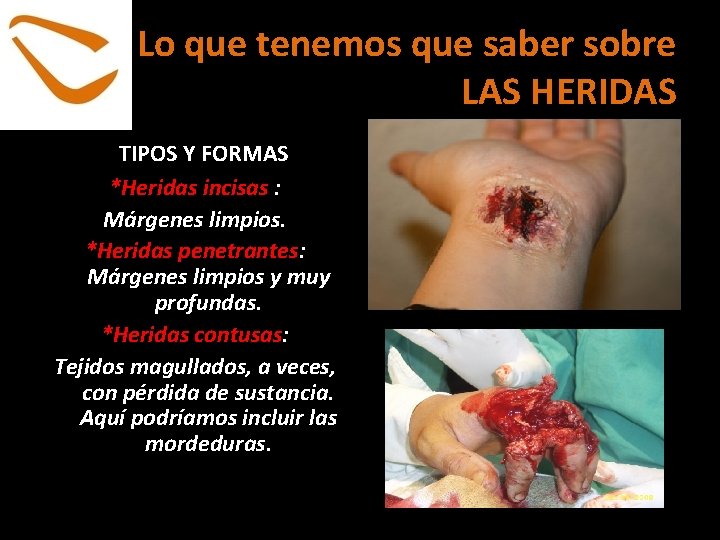 Lo que tenemos que saber sobre LAS HERIDAS TIPOS Y FORMAS *Heridas incisas :