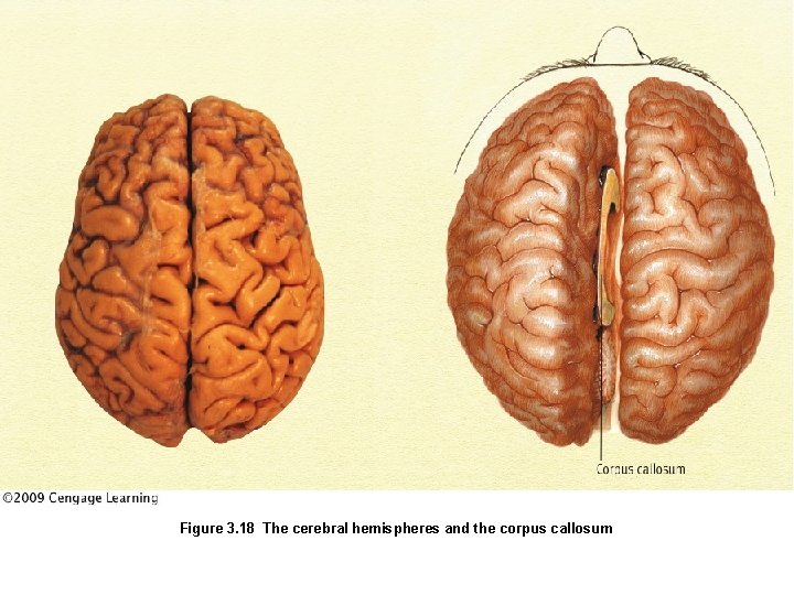 Figure 3. 18 The cerebral hemispheres and the corpus callosum 