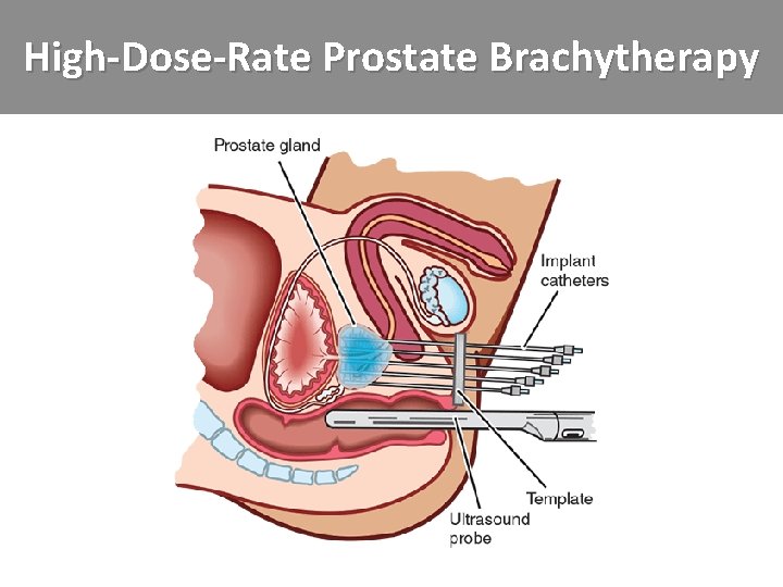 High-Dose-Rate Prostate Brachytherapy 