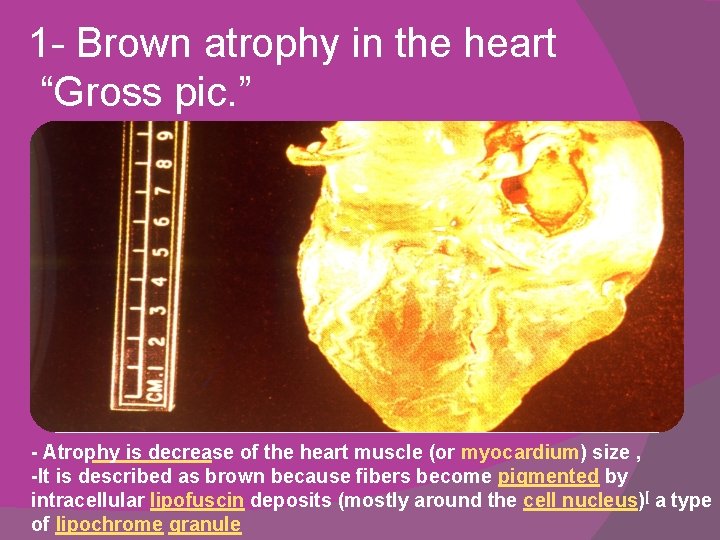 1 - Brown atrophy in the heart “Gross pic. ” - Atrophy is decrease 1 - Brown atrophy in the heart “Gross pic. ” - Atrophy is decrease
