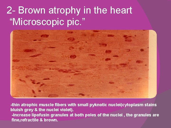 2 - Brown atrophy in the heart “Microscopic pic. ” -thin atrophic muscle fibers 2 - Brown atrophy in the heart “Microscopic pic. ” -thin atrophic muscle fibers