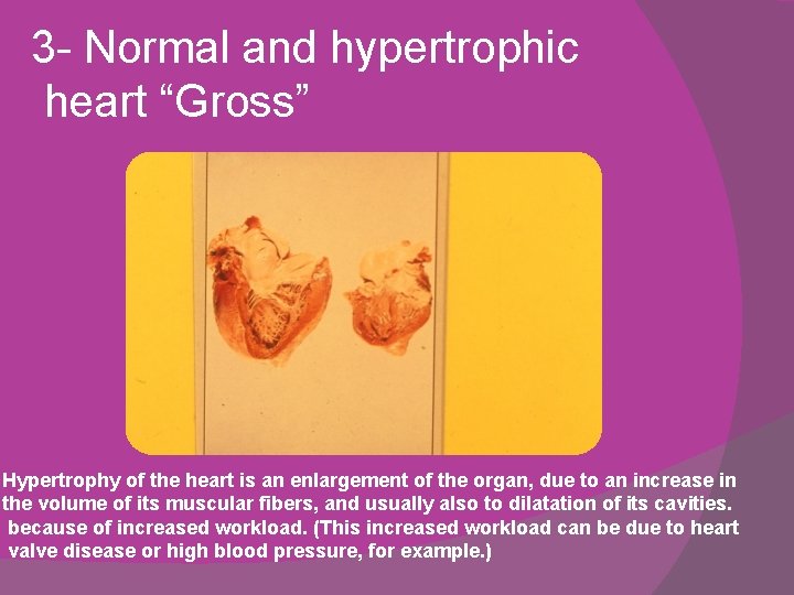 3 - Normal and hypertrophic heart “Gross” Hypertrophy of the heart is an enlargement 3 - Normal and hypertrophic heart “Gross” Hypertrophy of the heart is an enlargement