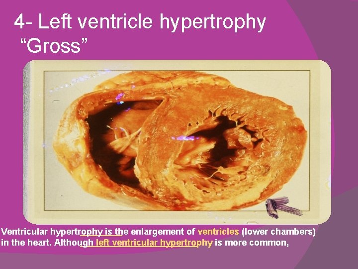 4 - Left ventricle hypertrophy “Gross” Ventricular hypertrophy is the enlargement of ventricles (lower 4 - Left ventricle hypertrophy “Gross” Ventricular hypertrophy is the enlargement of ventricles (lower