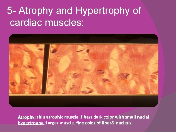 5 - Atrophy and Hypertrophy of cardiac muscles: Atrophy: thin atrophic muscle , fibers 5 - Atrophy and Hypertrophy of cardiac muscles: Atrophy: thin atrophic muscle , fibers