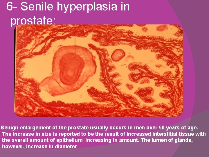 6 - Senile hyperplasia in prostate: Benign enlargement of the prostate usually occurs in 6 - Senile hyperplasia in prostate: Benign enlargement of the prostate usually occurs in