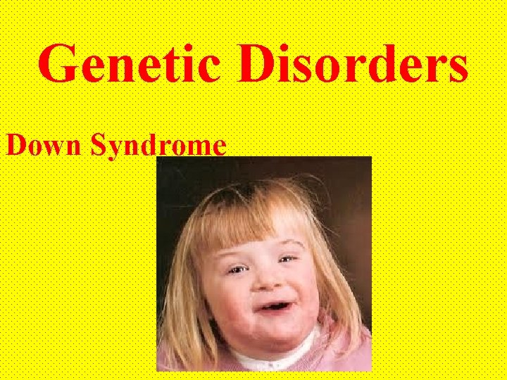 Genetic Disorders Down Syndrome 