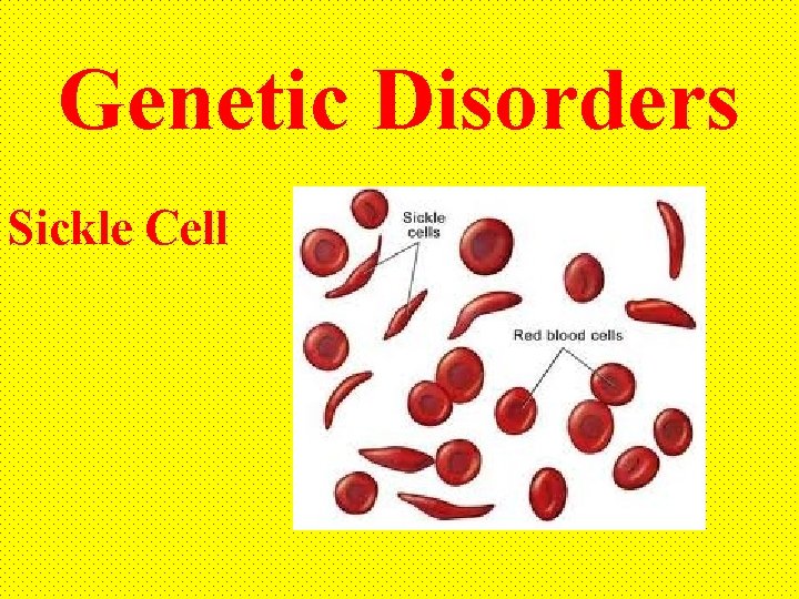 Genetic Disorders Sickle Cell 