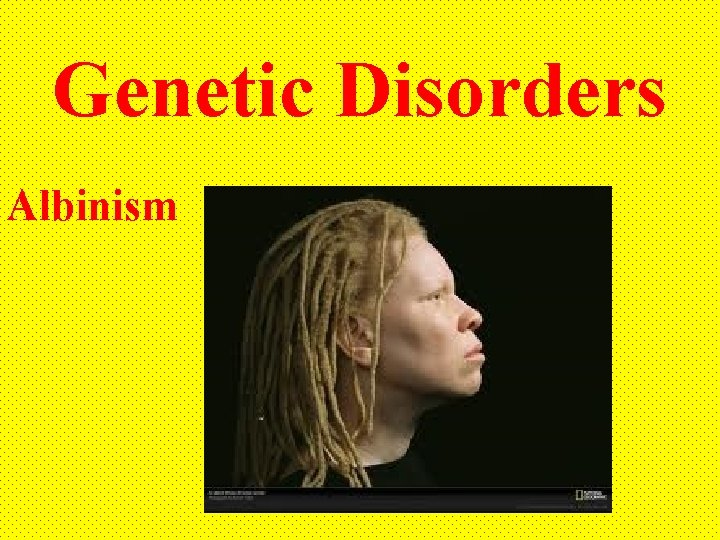 Genetic Disorders Albinism 