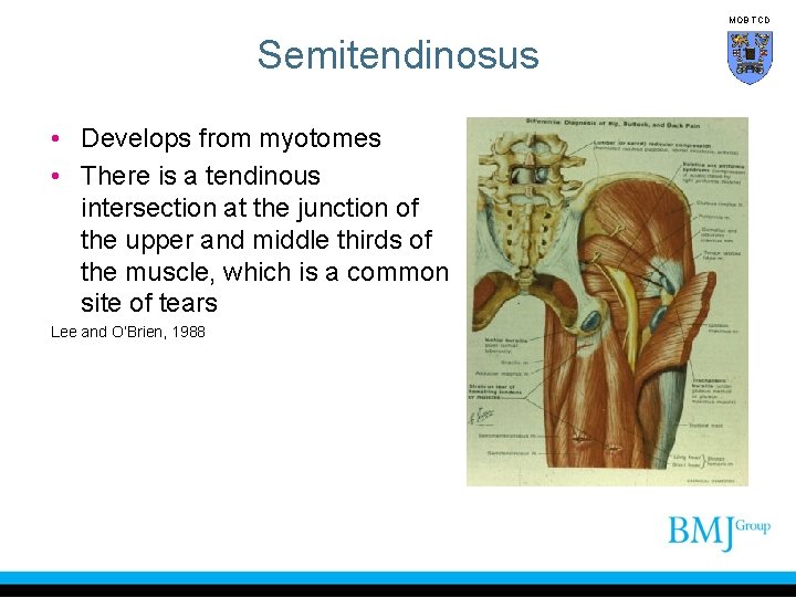 MOB TCD Semitendinosus • Develops from myotomes • There is a tendinous intersection at