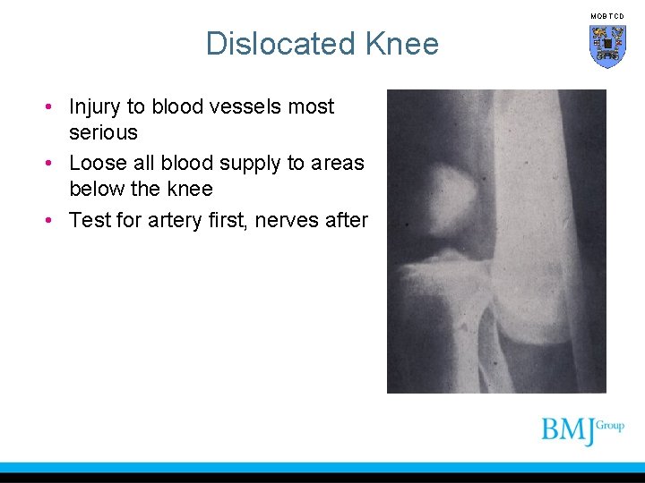 MOB TCD Dislocated Knee • Injury to blood vessels most serious • Loose all