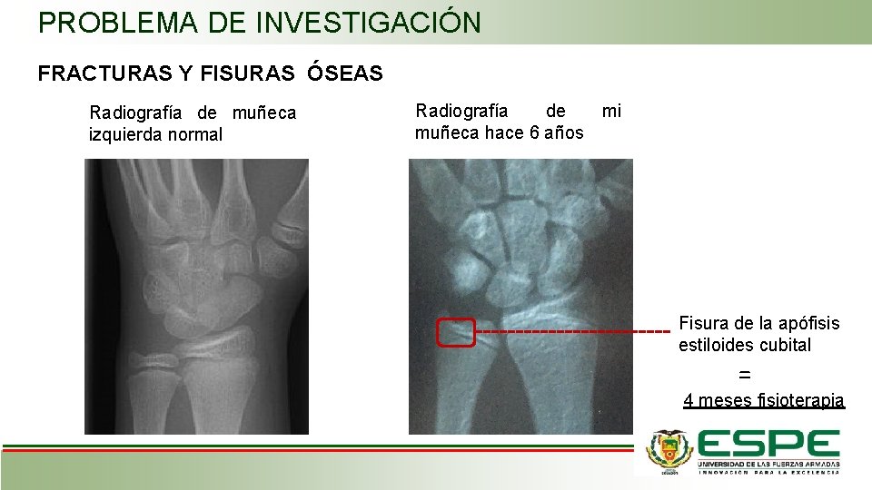 PROBLEMA DE INVESTIGACIÓN FRACTURAS Y FISURAS ÓSEAS Radiografía de muñeca izquierda normal Radiografía de