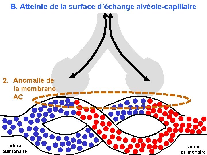 B. Atteinte de la surface d’échange alvéole-capillaire 2. Anomalie de la membrane AC artère
