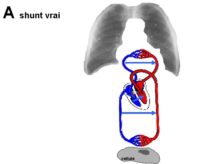 A shunt vrai poumon cellule 