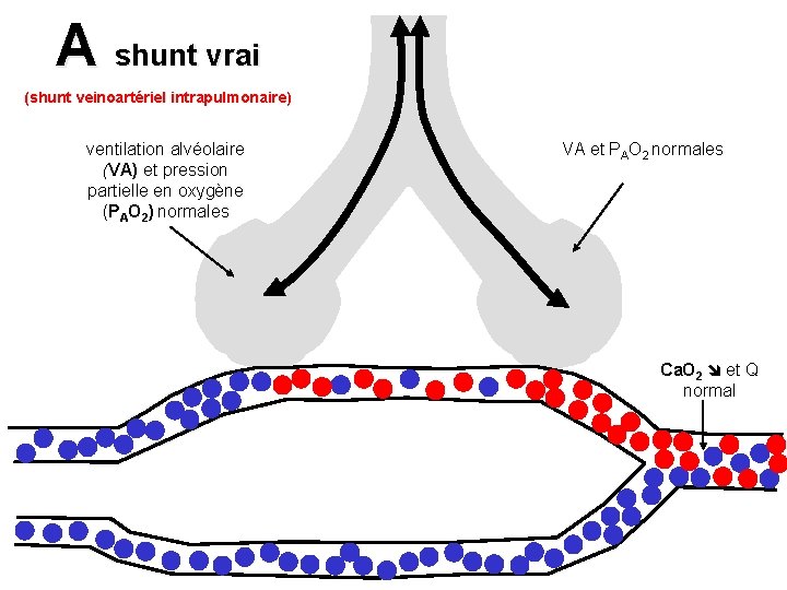 A shunt vrai (shunt veinoartériel intrapulmonaire) ventilation alvéolaire (VA) et pression partielle en oxygène