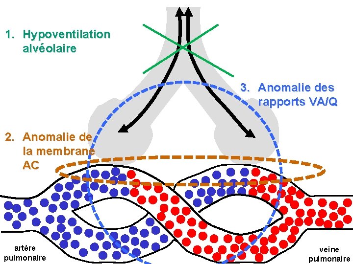 1. Hypoventilation alvéolaire 3. Anomalie des rapports VA/Q 2. Anomalie de la membrane AC