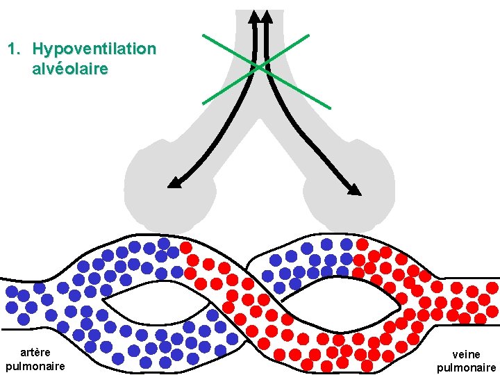 1. Hypoventilation alvéolaire artère pulmonaire veine pulmonaire 