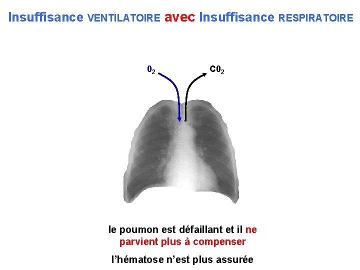 Insuffisance VENTILATOIRE avec Insuffisance RESPIRATOIRE 02 C 02 le poumon est défaillant et il