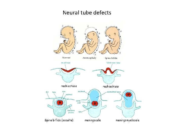 Neural tube defects 