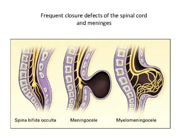 Frequent closure defects of the spinal cord and meninges 