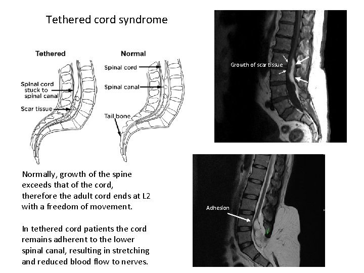 Tethered cord syndrome Growth of scar tissue Normally, growth of the spine exceeds that