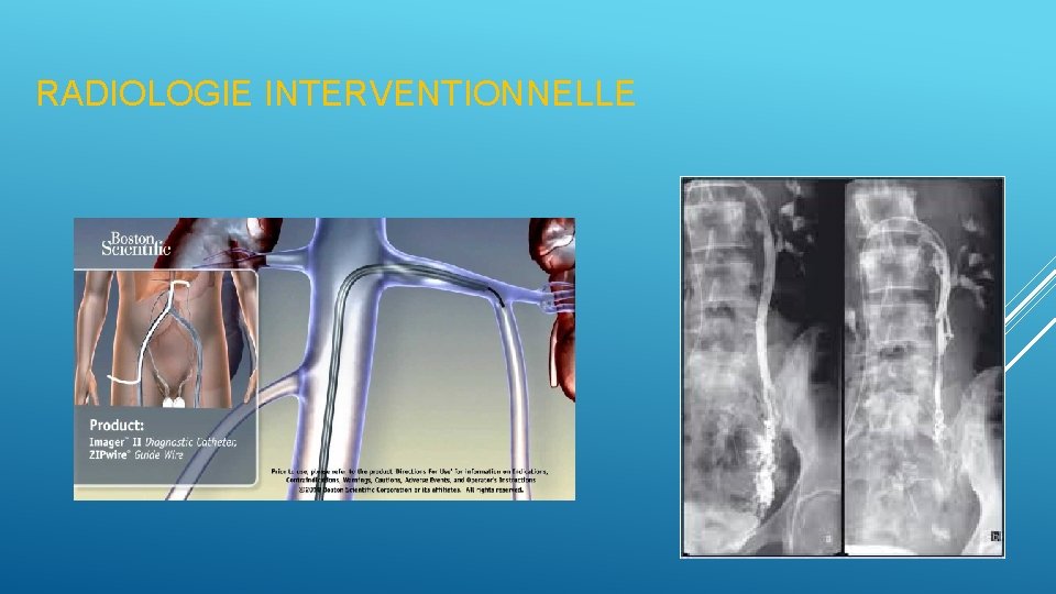 RADIOLOGIE INTERVENTIONNELLE 