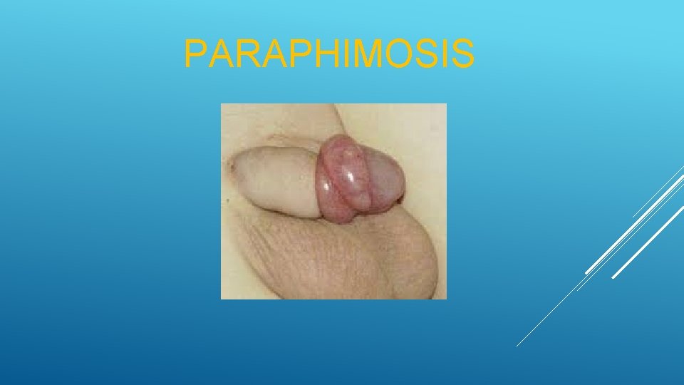 PARAPHIMOSIS 